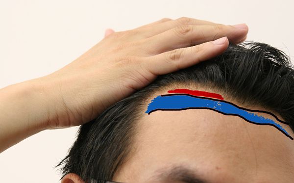 發際線為什么會后移,發際線后移該怎么辦