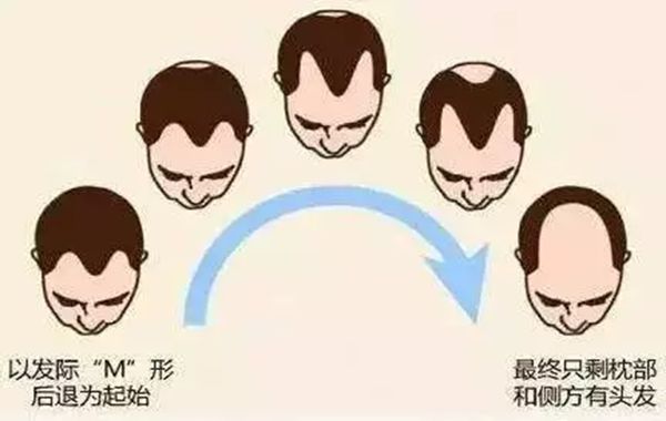 發際線為什么會后移,發際線后移該怎么辦