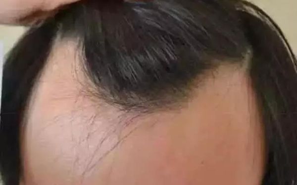 發際線為什么會后移,發際線后移該怎么辦